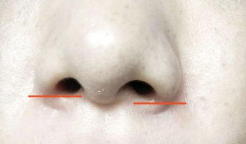 成人唇腭鼻子修复视频,成人唇腭鼻子修复手术全解析-第3张图片-成人抖抈app