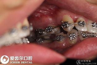 牙齿再生成人案例视频,重拾微笑的突破性案例揭秘-第1张图片-成人抖抈app