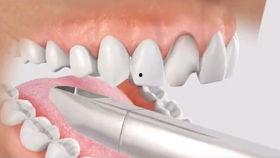 牙齿再生成人案例视频,重拾微笑的突破性案例揭秘-第2张图片-成人抖抈app
