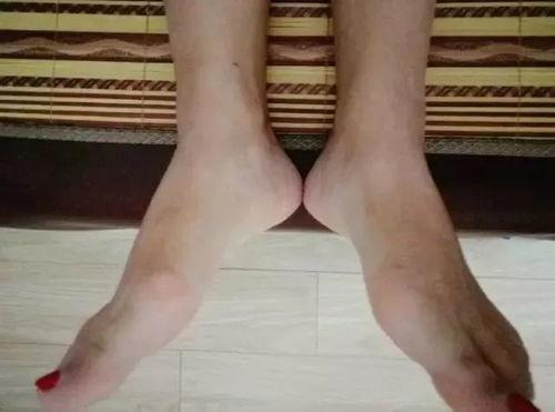 成人长短腿治疗方法视频,跟随专业视频，轻松掌握成人长短腿治疗技巧-第2张图片-成人抖抈app